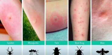 Mușcături și înțepături de insecte la copii. Care este diferența dintre ele și când trebuie să mergeți la doctor | Demamici.ro