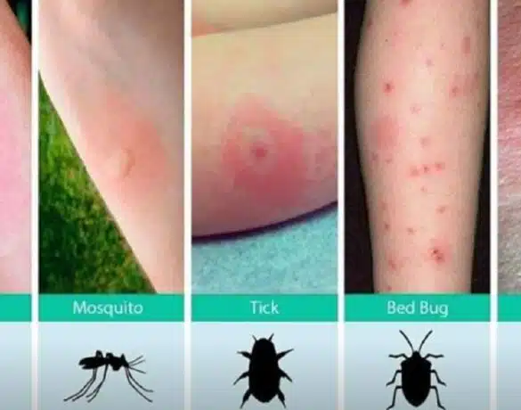 Mușcături și înțepături de insecte la copii. Care este diferența dintre ele și când trebuie să mergeți la doctor | Demamici.ro