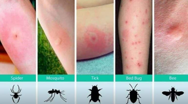 Mușcături și înțepături de insecte la copii. Care este diferența dintre ele și când trebuie să mergeți la doctor | Demamici.ro