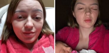 I-a ieșit ochiul din orbită în timpul nașterii. Mămica povestește că abia după 6 săptămâni și-a revenit complet | Demamici.ro