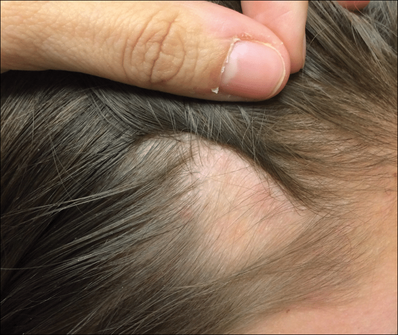 Tricotilomania, obiceiul incontrolabil de smulgere a părului