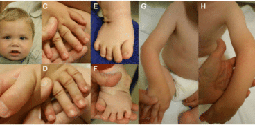 Sindromul Larsen sau deformarea oaselor la bebeluși: cauze, simptome și tratament | Demamici.ro