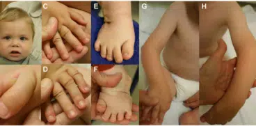 Sindromul Larsen sau deformarea oaselor la bebeluși: cauze, simptome și tratament | Demamici.ro