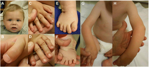 Sindromul Larsen sau deformarea oaselor la bebeluși: cauze, simptome și tratament | Demamici.ro