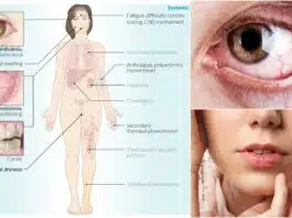 Sindromul Sjögren la copii sau uscăciunea ochilor și a gurii | Demamici.ro