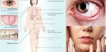 Sindromul Sjögren la copii sau uscăciunea ochilor și a gurii | Demamici.ro