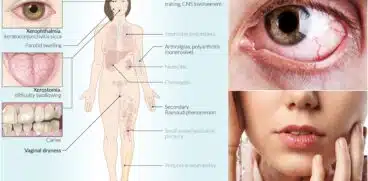 Sindromul Sjögren la copii sau uscăciunea ochilor și a gurii | Demamici.ro