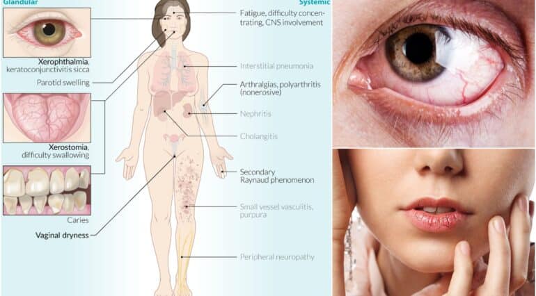 Sindromul Sjögren la copii sau uscăciunea ochilor și a gurii | Demamici.ro