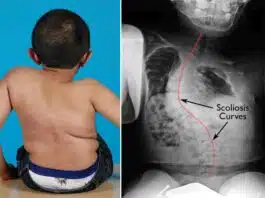 Osteogeneza imperfecta sau boala oaselor de sticlă la copii: simptome, diagnostic și tratament | Demamici.ro