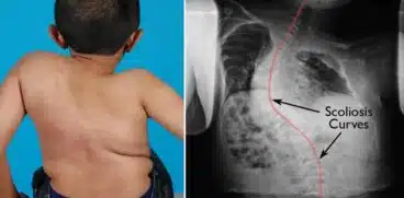 Osteogeneza imperfecta sau boala oaselor de sticlă la copii: simptome, diagnostic și tratament | Demamici.ro