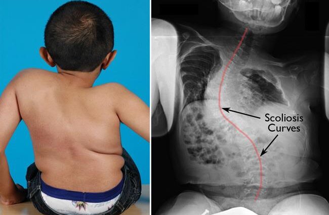 Osteogeneza imperfecta sau boala oaselor de sticlă la copii: simptome, diagnostic și tratament | Demamici.ro