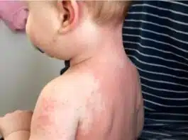 Boala Kawasaki, risc major de afectare a inimii la copii. Cauze, simptome și tratament | Demamici.ro