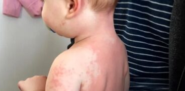 Boala Kawasaki, risc major de afectare a inimii la copii. Cauze, simptome și tratament | Demamici.ro