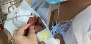 Ziua Mondială a Prematurității. O fetiță de nici 500 de grame, cel mai mic prematur născut la Spitalul Universitar din București | Demamici.ro