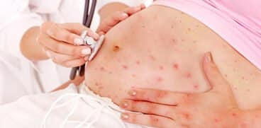 Varicela în sarcină! Care sunt riscurile pentru mamă și bebeluș, asociate acestei afecțiuni | Demamici.ro