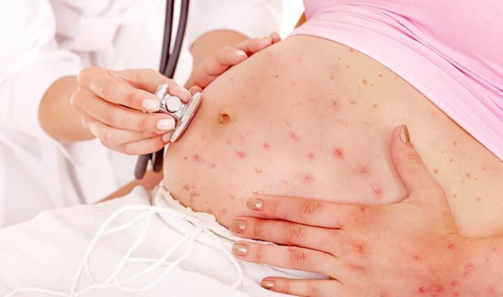 Varicela în sarcină! Care sunt riscurile pentru mamă și bebeluș, asociate acestei afecțiuni | Demamici.ro