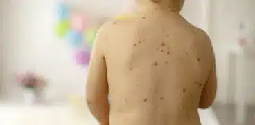 Varicela („vărsatul de vânt”): simptome, cauze, tratament. Soluții pentru atenuarea mâncărimilor și reducerea riscului de apariție a cicatricilor (P) | Demamici.ro