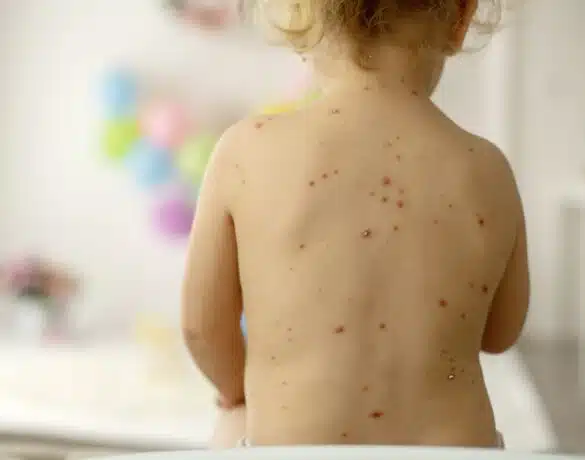 Varicela („vărsatul de vânt”): simptome, cauze, tratament. Soluții pentru atenuarea mâncărimilor și reducerea riscului de apariție a cicatricilor (P) | Demamici.ro