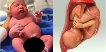 Macrosomia fetală – ce este și cum se manifestă | Demamici.ro