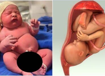 Macrosomia fetală – ce este și cum se manifestă | Demamici.ro