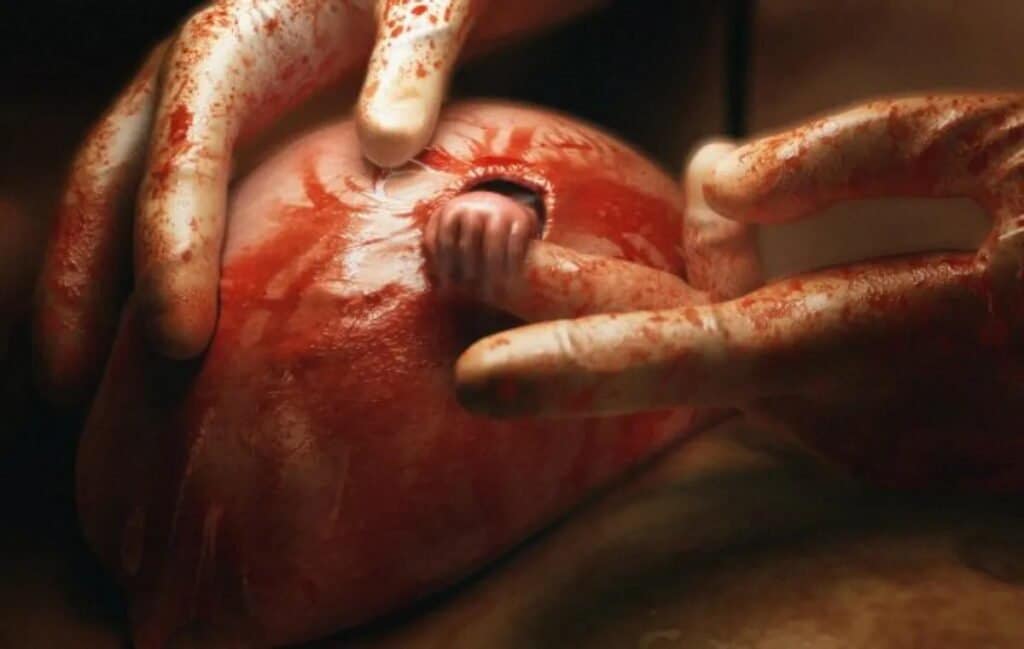 Copilul care s-a agățat de viață. Cum arată acum băiatul din celebra fotografie "Mâna speranței"
