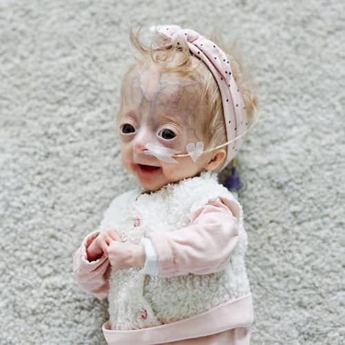 Lecția de viață a fetiței care s-a născut cu progeria, "boala bătrâneții": "Am știut imediat că e altfel decât ceilalți bebeluși"