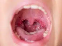 Atenție, părinți! Ce spun specialiștii despre infecția cu streptococul beta-hemolitic | Demamici.ro