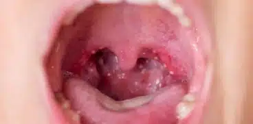 Atenție, părinți! Ce spun specialiștii despre infecția cu streptococul beta-hemolitic | Demamici.ro