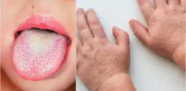 Scarlatina la copii: simptome, tratament și măsuri de precauție | Demamici.ro