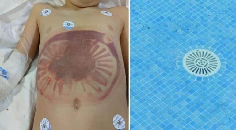 Pericolele din timpul verii. Un băiețel a fost salvat în ultimul moment după ce a fost aspirat de scurgerea din piscină