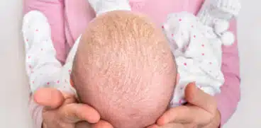 Crustele de lapte la bebeluși. Soluții și când să mergi la medic | Demamici.ro