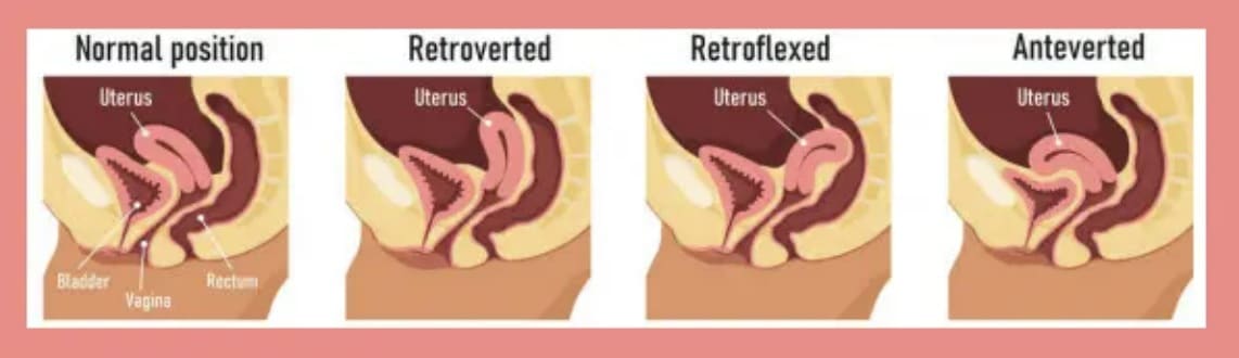 Uterul retrovers. Factori de risc, fertilitate și sarcină