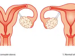 Uterul bicornuat sau uterul în formă de inimă. Cum afectează sarcina | Demamici.ro
