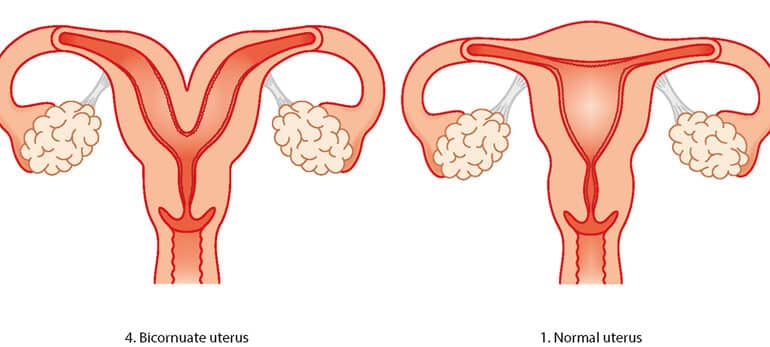 Anomalii ale uterului. Uterul bicornuat sau uterul în formă de inimă. Cum afectează sarcina