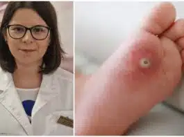 Verucile (negii) la copii. Ce sunt verucile (negii) și din ce cauză apar? Interviu cu Dr. Mihaela Balaban, Medic specialist Dermato-Venerologie | Demamici.ro