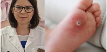 Verucile (negii) la copii. Ce sunt verucile (negii) și din ce cauză apar? Interviu cu Dr. Mihaela Balaban, Medic specialist Dermato-Venerologie | Demamici.ro
